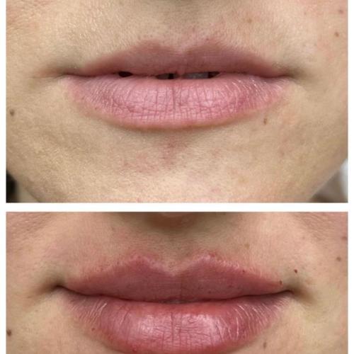 Botox Before / After photo